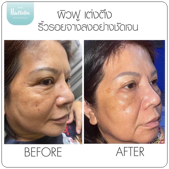 แฮวอนไฮยาฟิลเลอร์ HYA Filler Serum HAEWON ฟิลเลอร์แบบทา (ส่งฟรี)