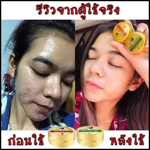 IRish White + Mira Serum เซตรักษาสิว ผิวขาวใส