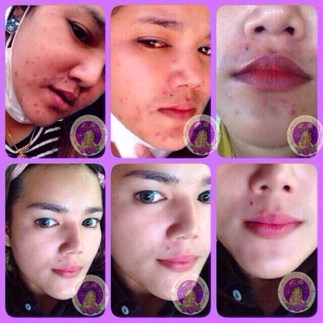 ใหม่ เซตครีมองุ่นหน้าใส K&K Beautiful (10กรัม)