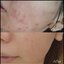 Bearoban Ointment ยาที่รักษาการอักเสบของผิว จากเกาหลี